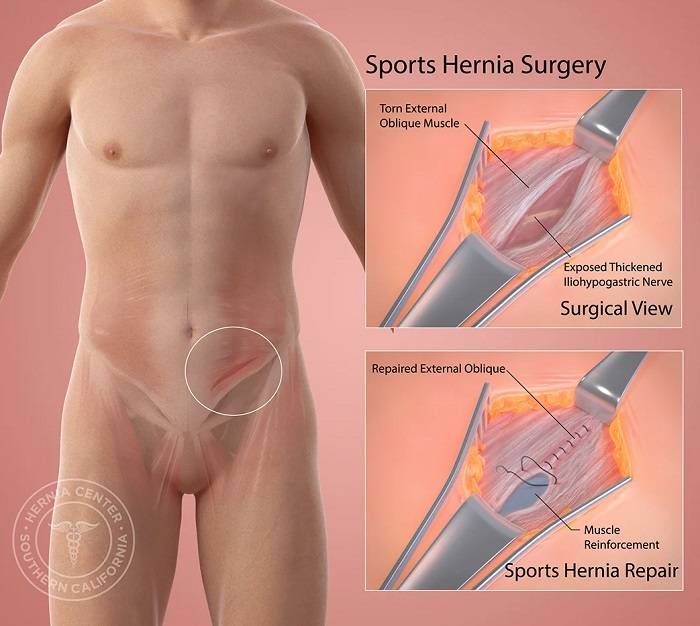 Diagnosis of a Sports Hernia