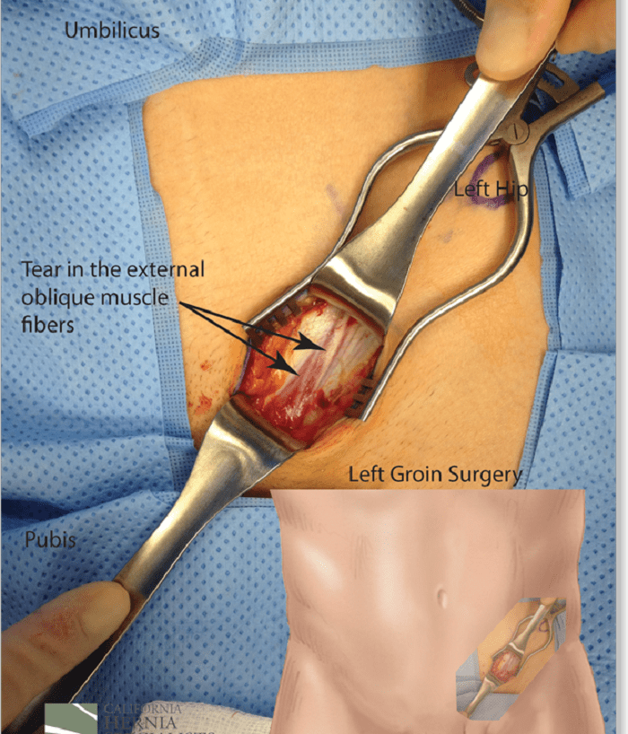 Diagnosis of a Sports Hernia